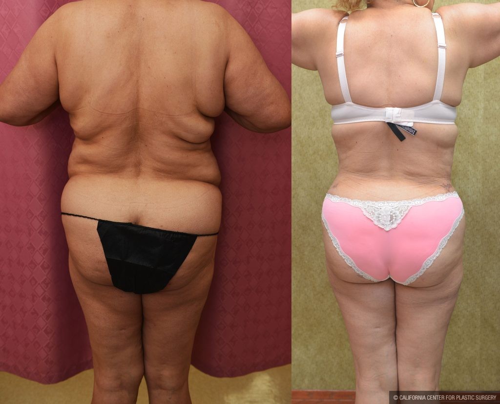 Tummy Tuck (Abdominoplasty) Plus Size Before & After Patient #13168