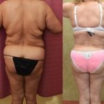 Tummy Tuck (Abdominoplasty) Plus Size Before & After Patient #13168