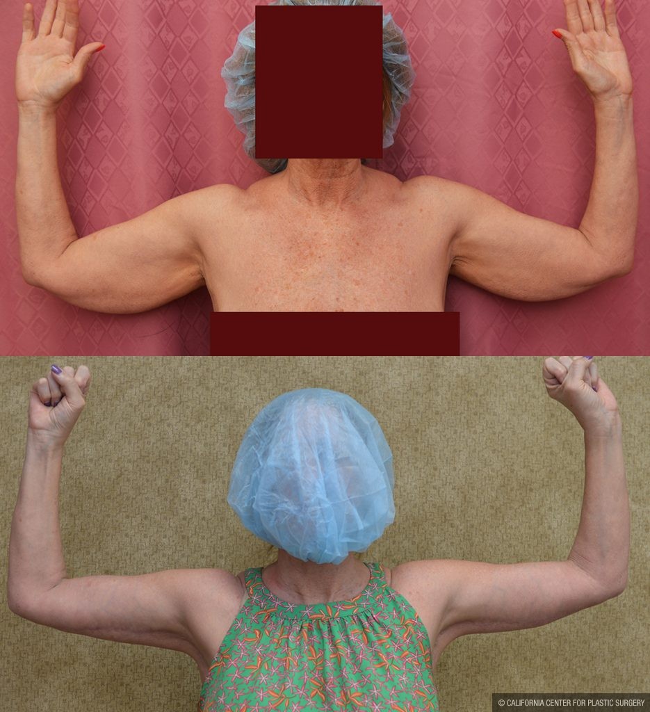 Arm Lift (Brachioplasty) Before & After Patient #13287