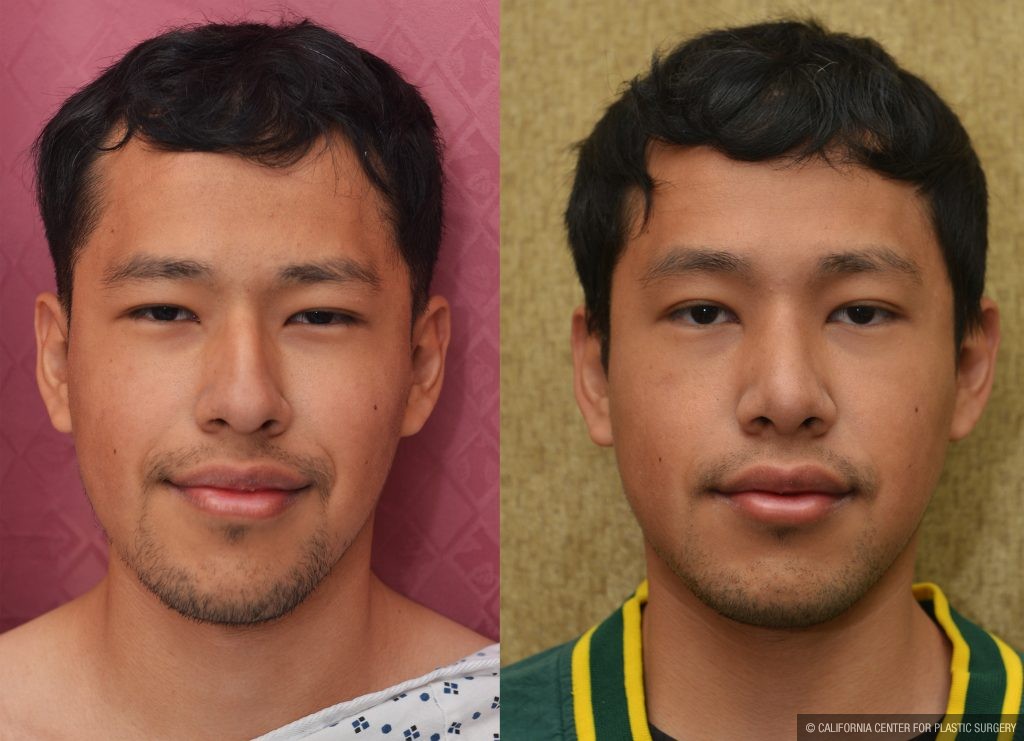 Rhinoplasty - Asian Before & After Patient #13290