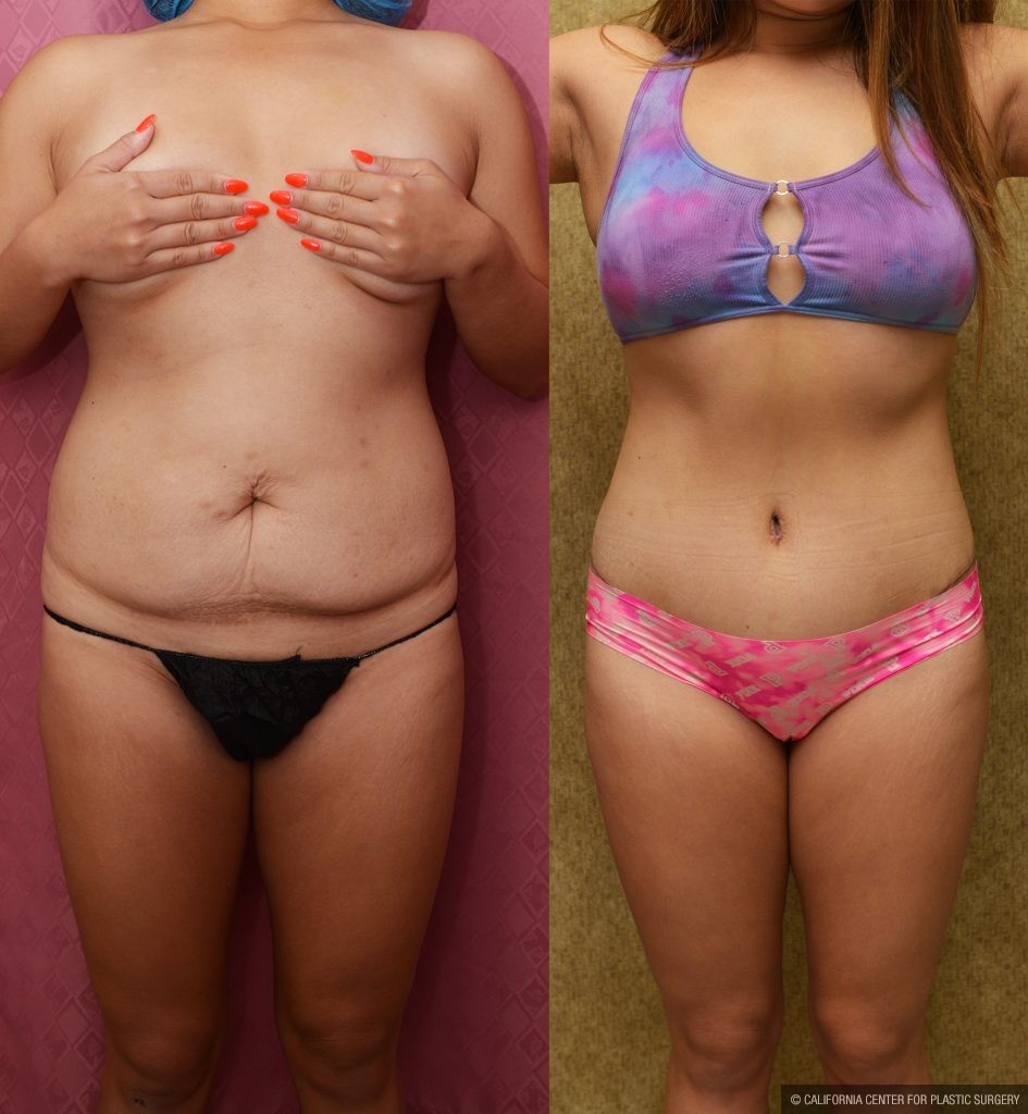 Tummy Tuck (Abdominoplasty) Medium Size Before & After Patient #13291