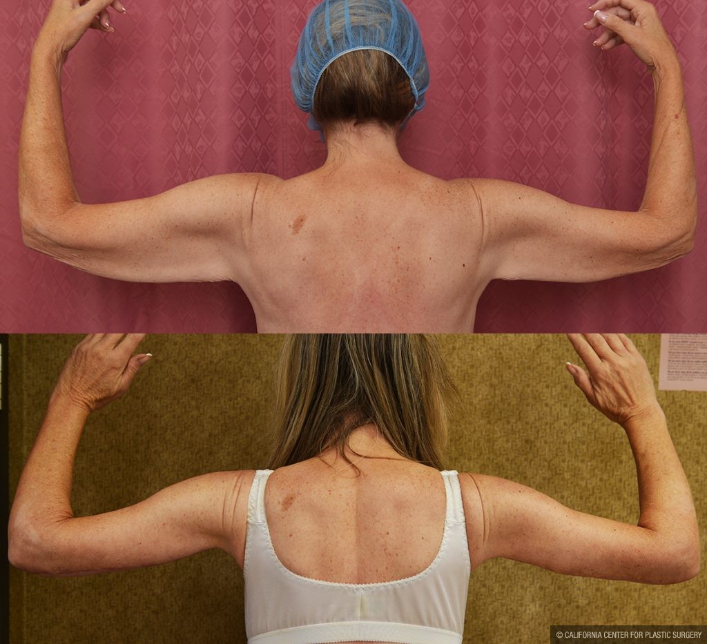 Arm Lift (Brachioplasty) Before & After Patient #13286