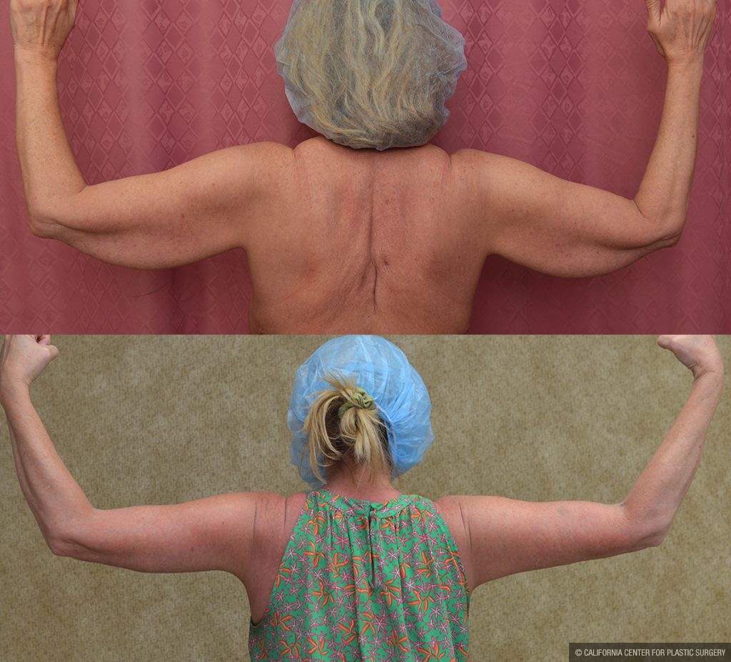 Arm Lift (Brachioplasty) Before & After Patient #13287