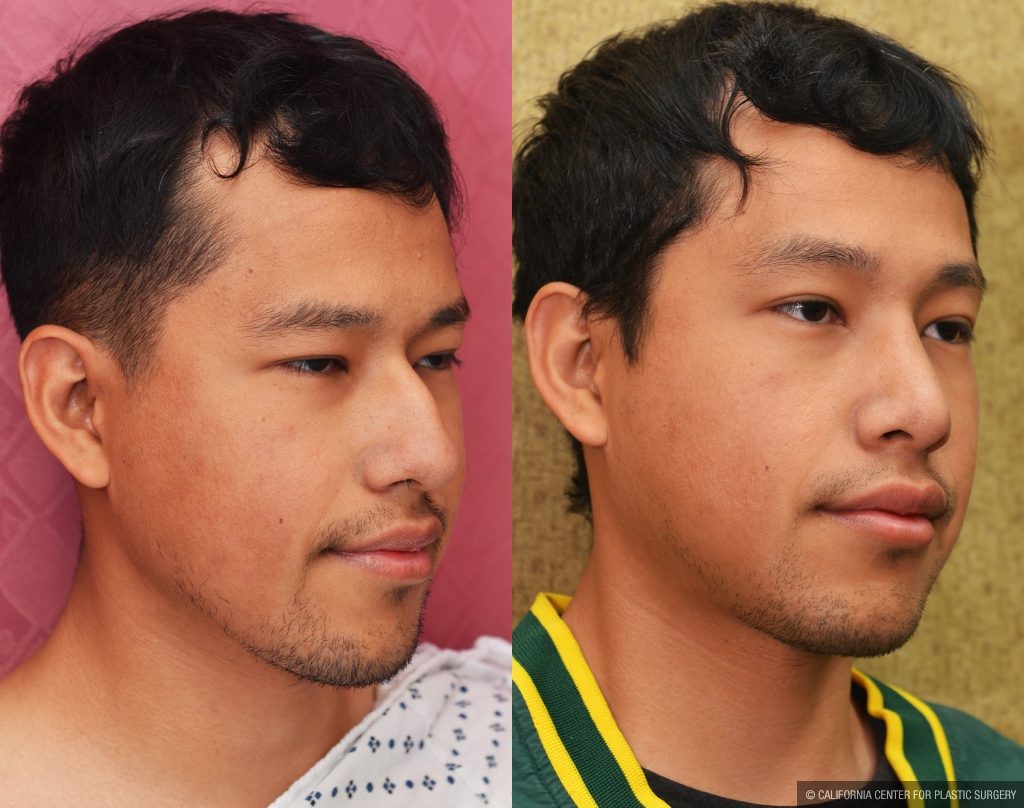 Rhinoplasty - Asian Before & After Patient #13290