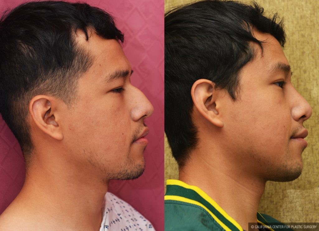 Rhinoplasty - Asian Before & After Patient #13290