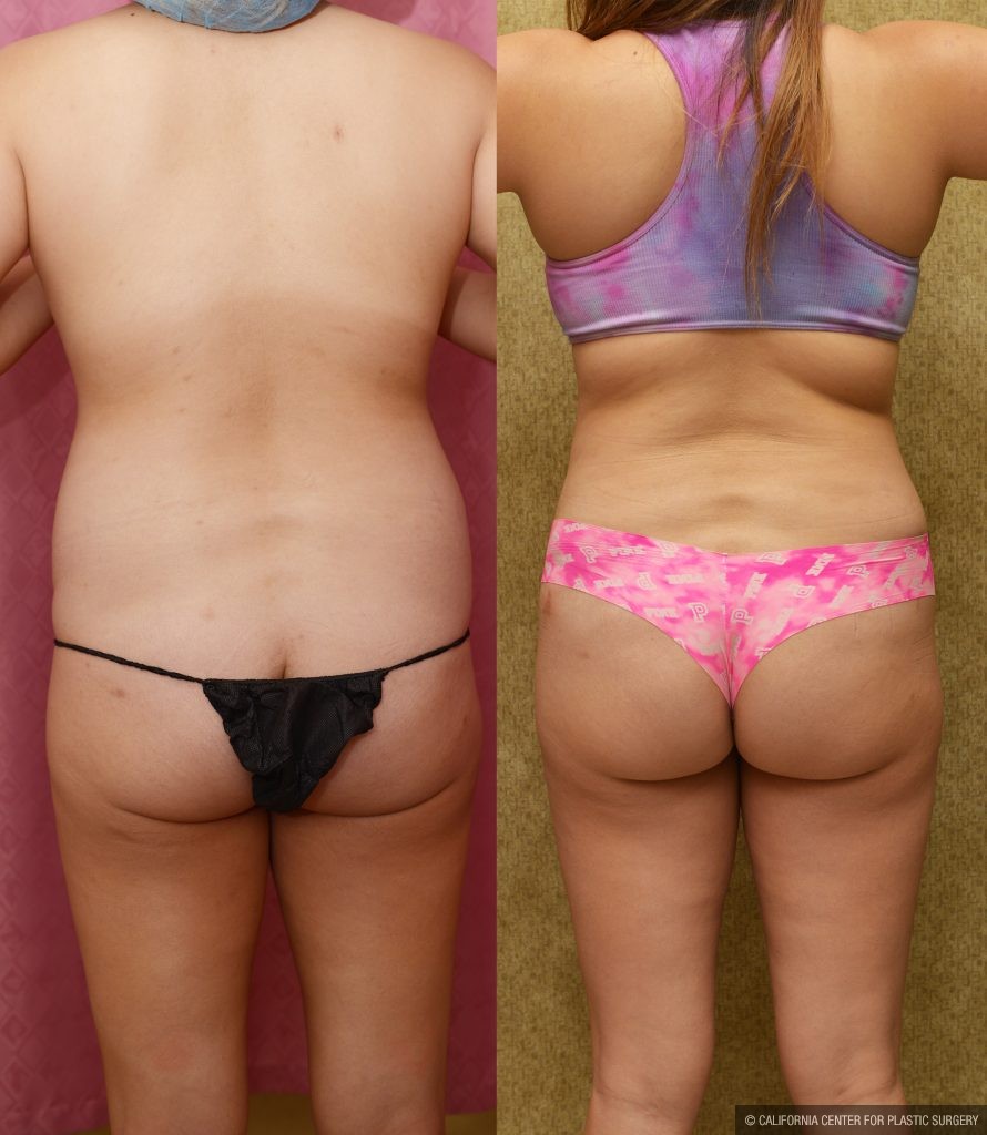 Tummy Tuck (Abdominoplasty) Medium Size Before & After Patient #13291